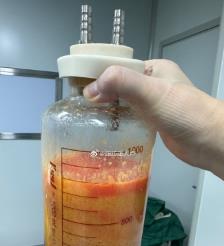 临朐水动力吸脂手术要做多久？